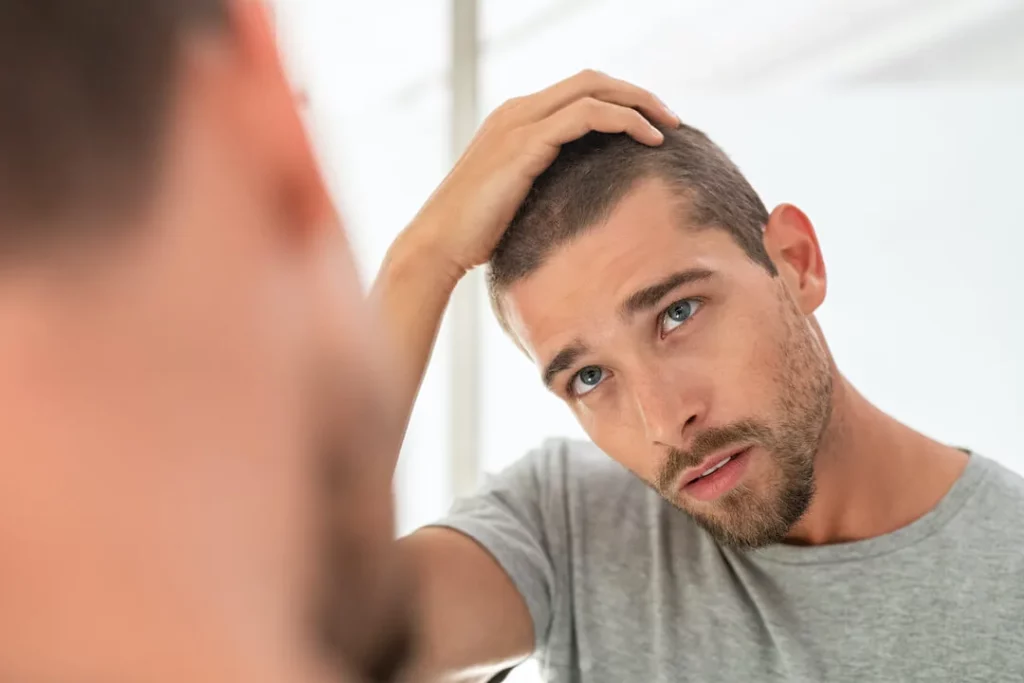 تساقط الشعر والصلع قد يصيب الرجال والنساء وهو على الأغلب وراثي