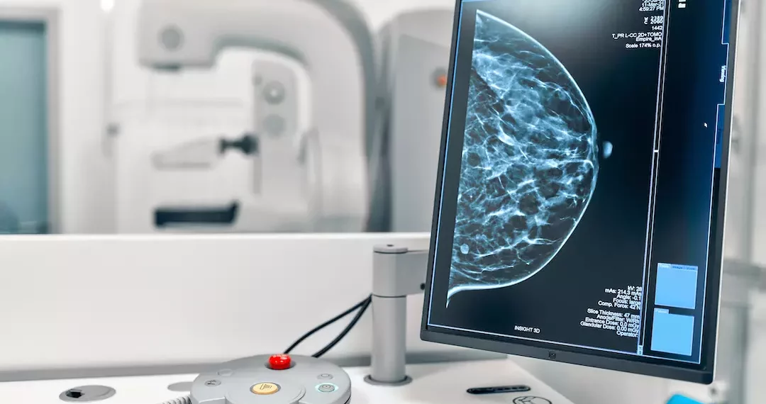 دراسة طبية - الذكاء الاصطناعي يسهم في الكشف المبكر عن سرطان الثدي